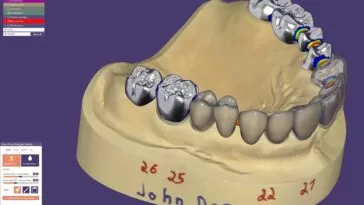 O que é Exocad e como ele funciona?